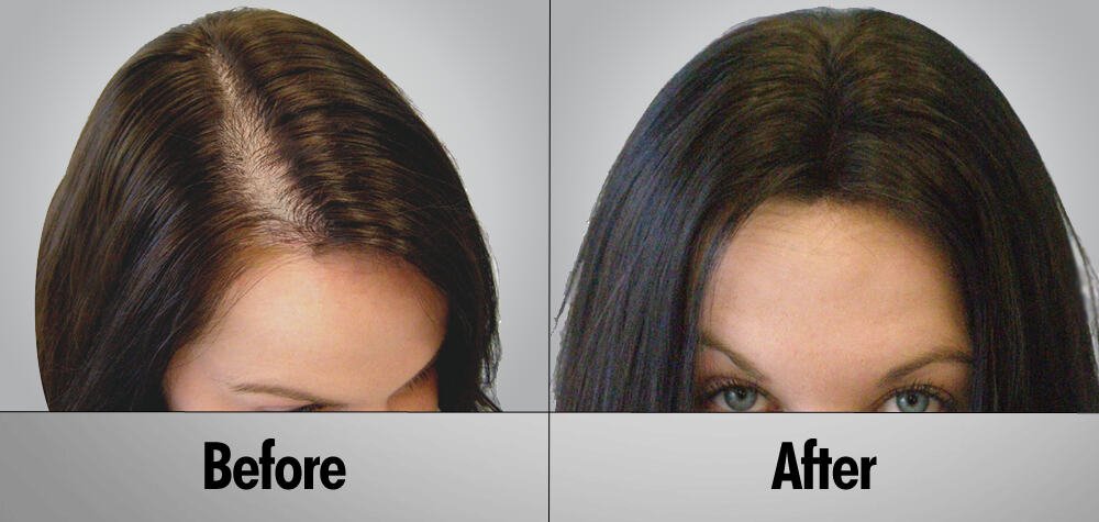 female hair transplant success rate