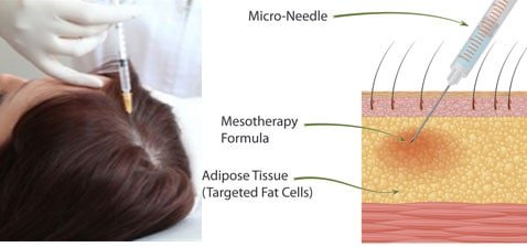 mesotherapy-for-hairloss[1]