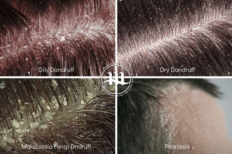 Types of Dandruff