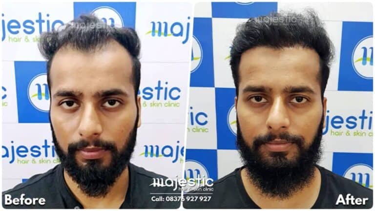 FUE Hair Transplant Before After Results