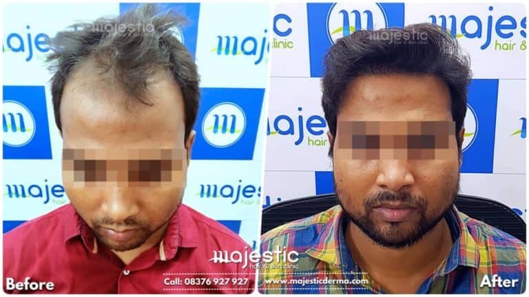 LP Hair Transplant 2