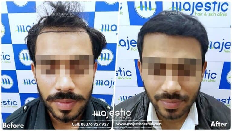 LP Hair Transplant 3