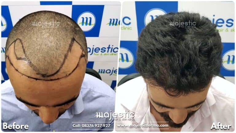 LP Hair Transplant 4