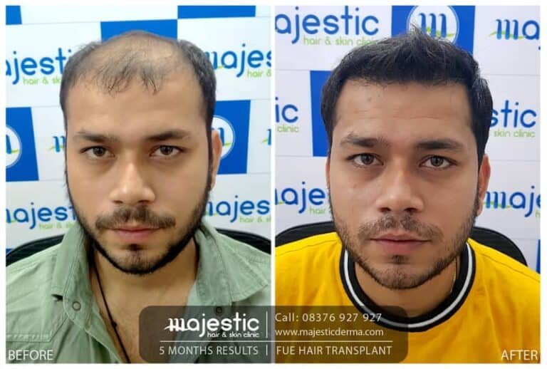 LP Hair Transplant 7