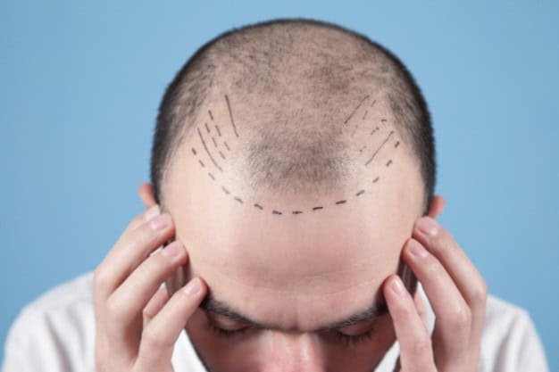 What is the Difference Between a Hair Transplant and FUE