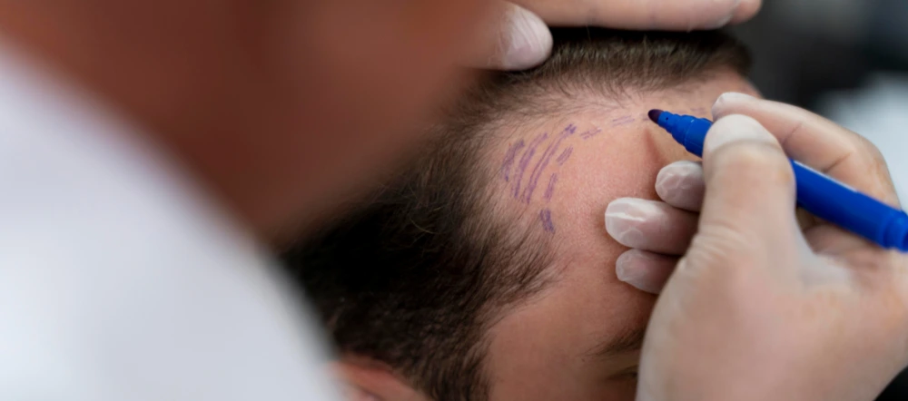 How Many Hair Grafts Are Required For Hair Transplantation