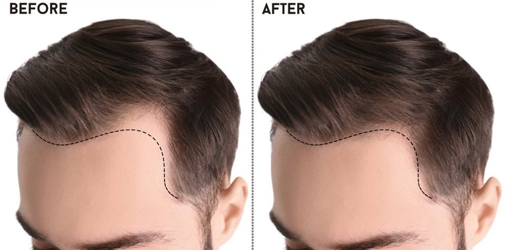 best-hair-transplant-in-Delhi