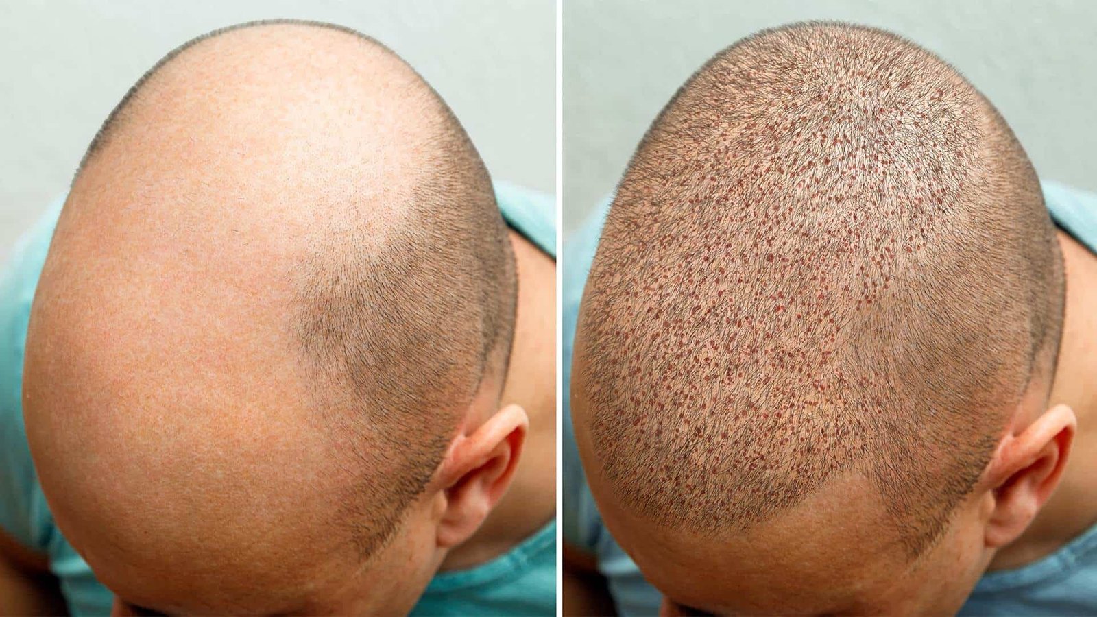 A Complete Beginner's Guide for Understanding Hair Transplants