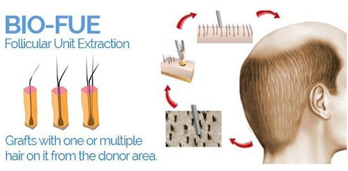 Bio FUE Hair Transplant - Procedure, Technique, Benefits And Side Effects