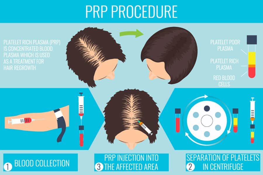 PRP Hair Treatment for Hair Loss