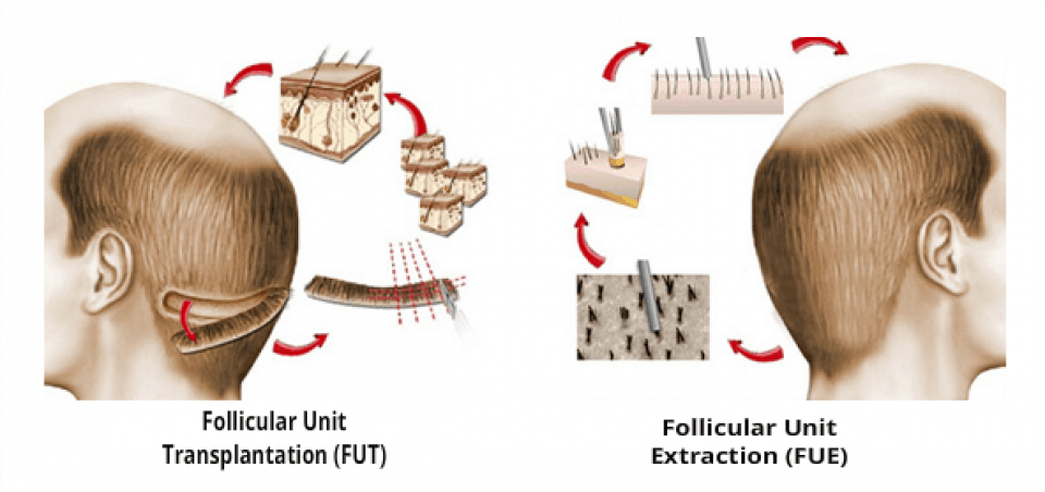 fue-fut-hair-transplant-technique[1]