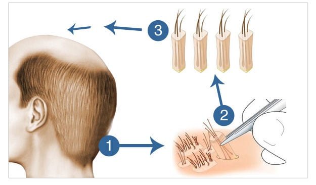 Does Hair Transplant Works For Female  Artius Hair Transplant