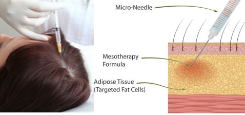 mesotherapy-for-hairloss[1]
