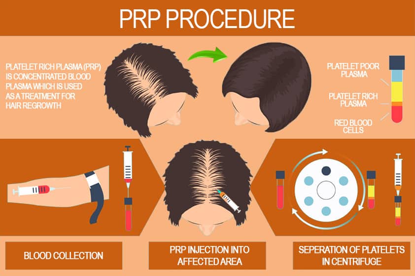 PRP Hair-Loss Therapy Treatment in Mexico $350