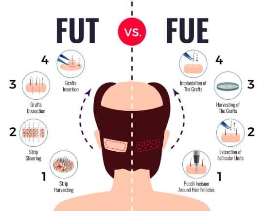 FUE Vs FUT Results - Majestic Derma