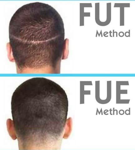 Female Hair Transplant  Women Hair Transplant Cost in India