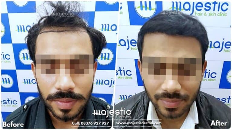 FUE Hair Transplant Before After Results