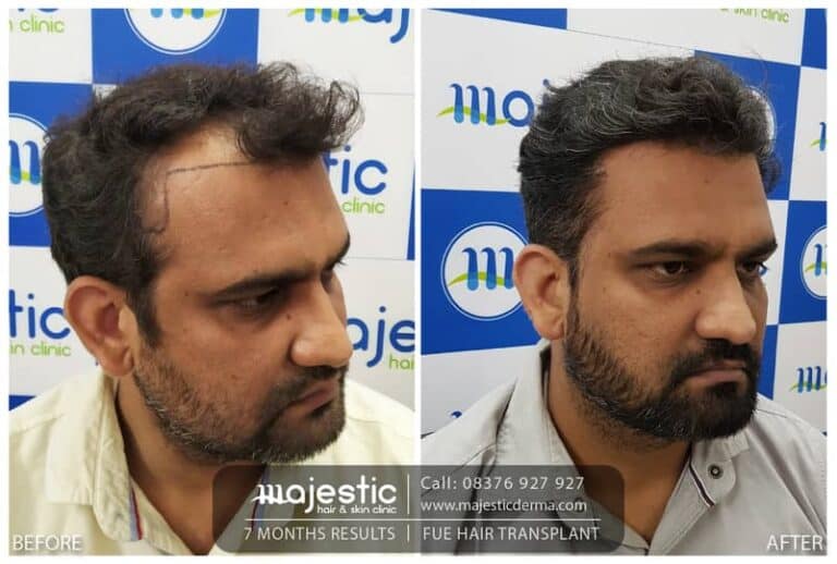 Amazing Hair Transplant Results in 6 Months | Majestic Hair And Skin Clinic  | Call: 08376927927 - YouTube