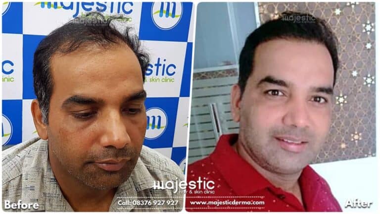 FUE Hair Transplant Before After Results