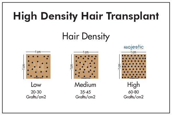 High Density Hair Transplant