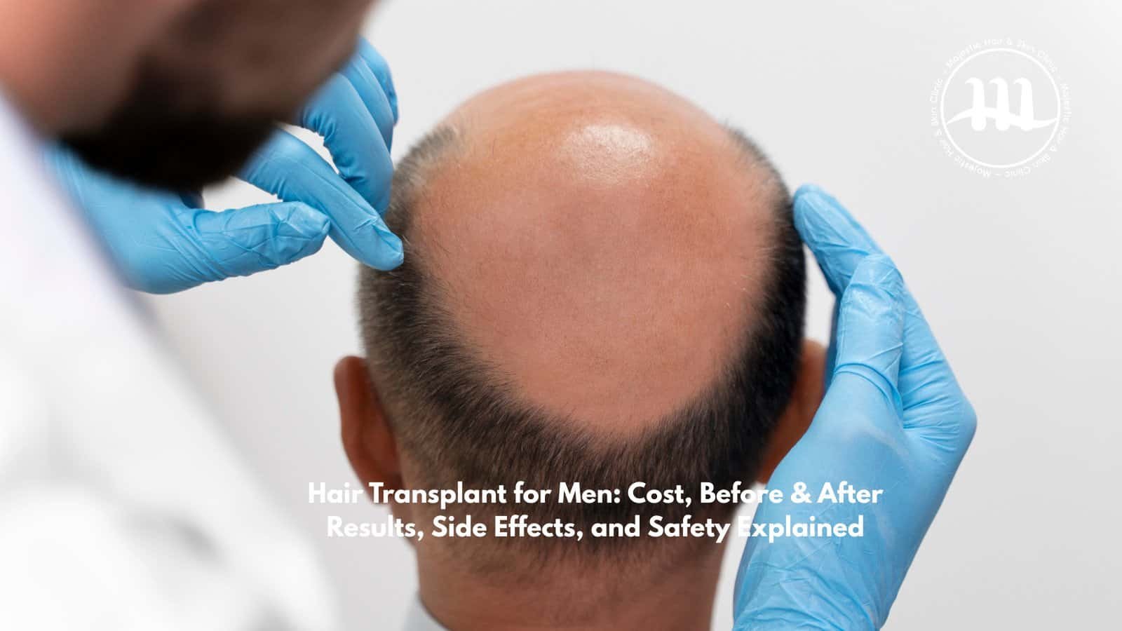 Hair Transplant for Men