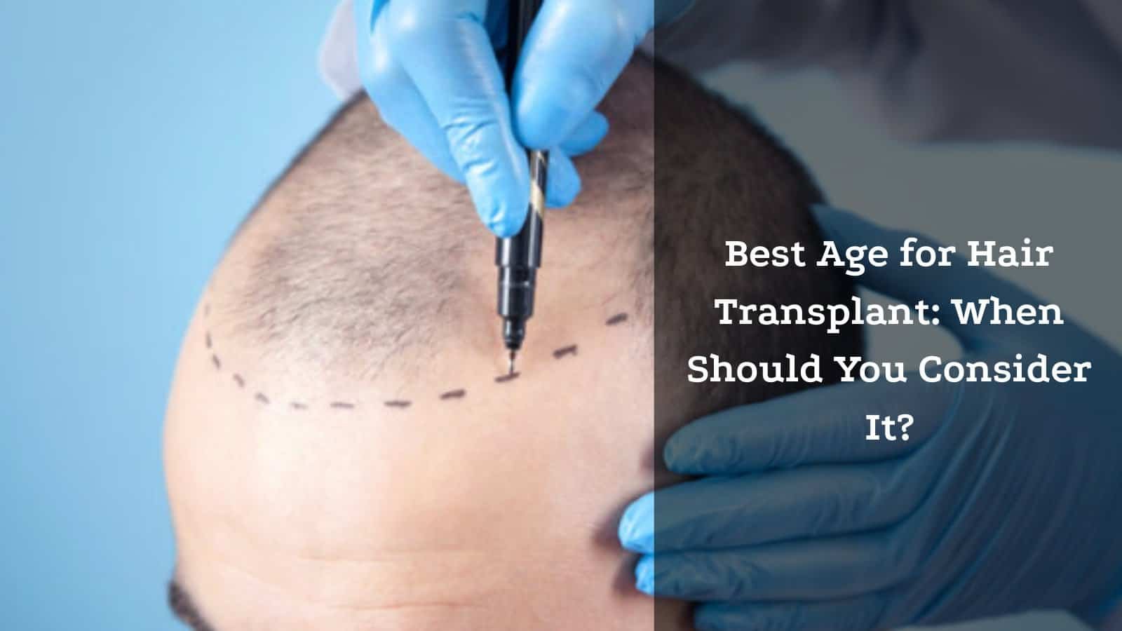 Best Age for Hair Transplant: When Should You Consider It?
