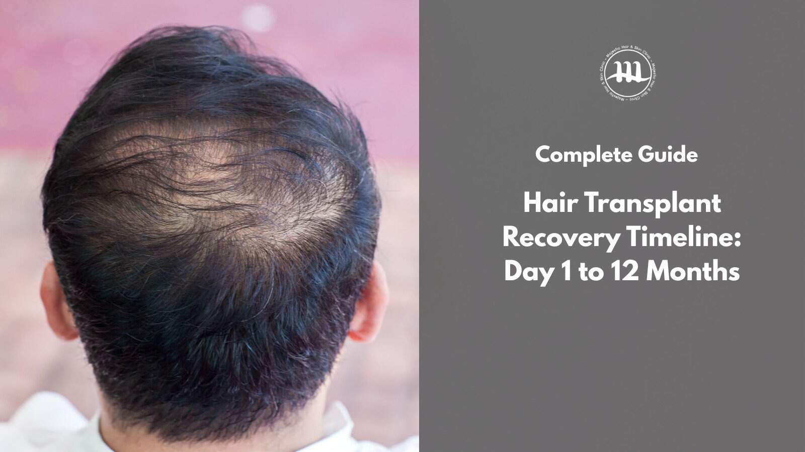 Hair Transplant Recovery Timeline: Day 1 to 12 Months