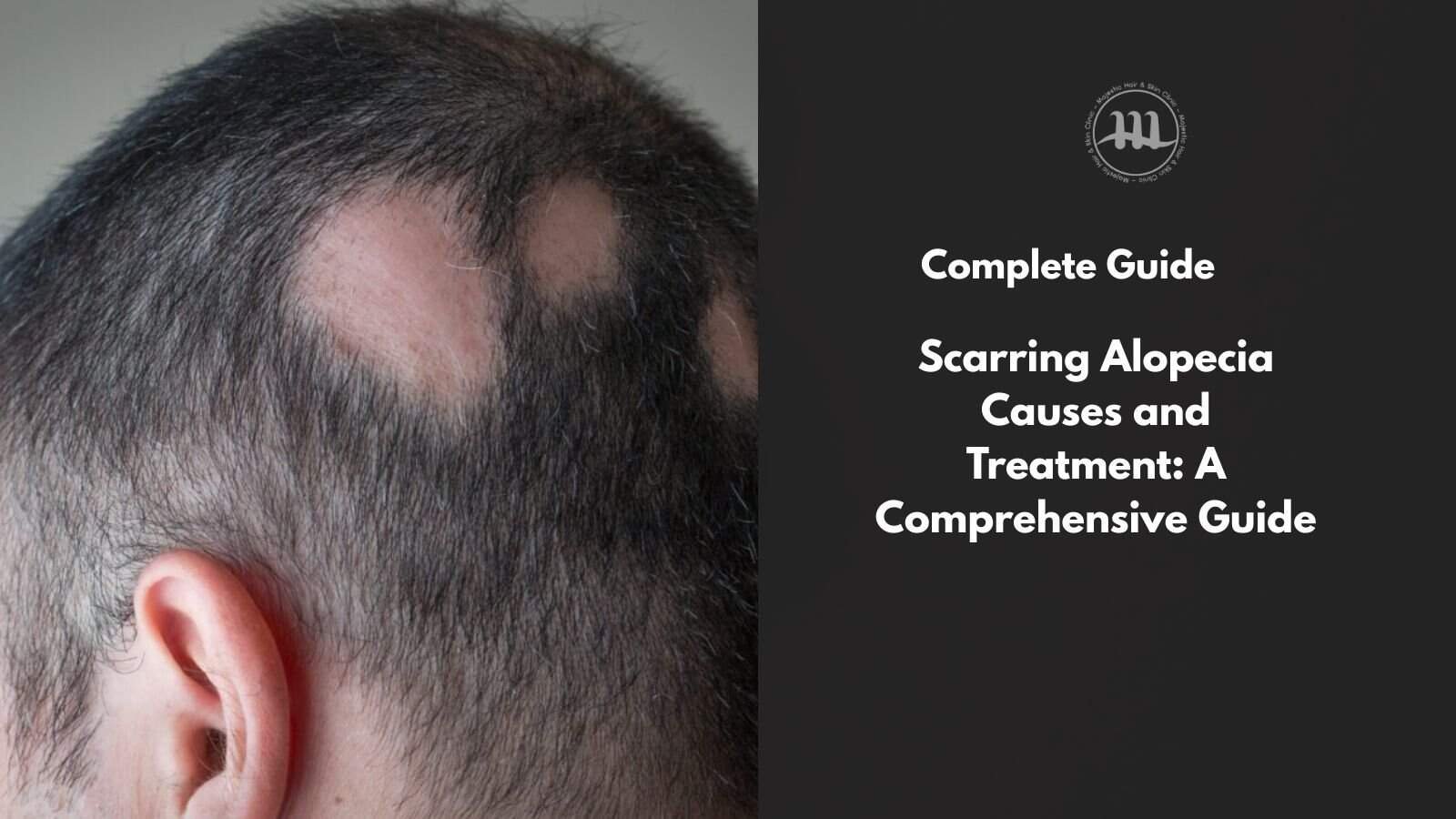 Scarring Alopecia Causes and Treatment: A Comprehensive Guide