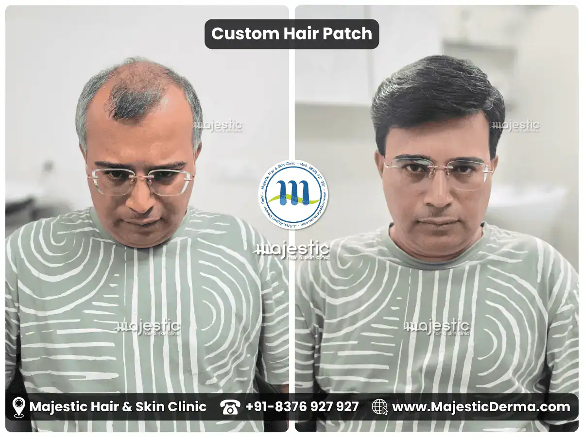 Before and after photos of a man with hair loss fitted with a hair patch at Majestic Derma, Delhi