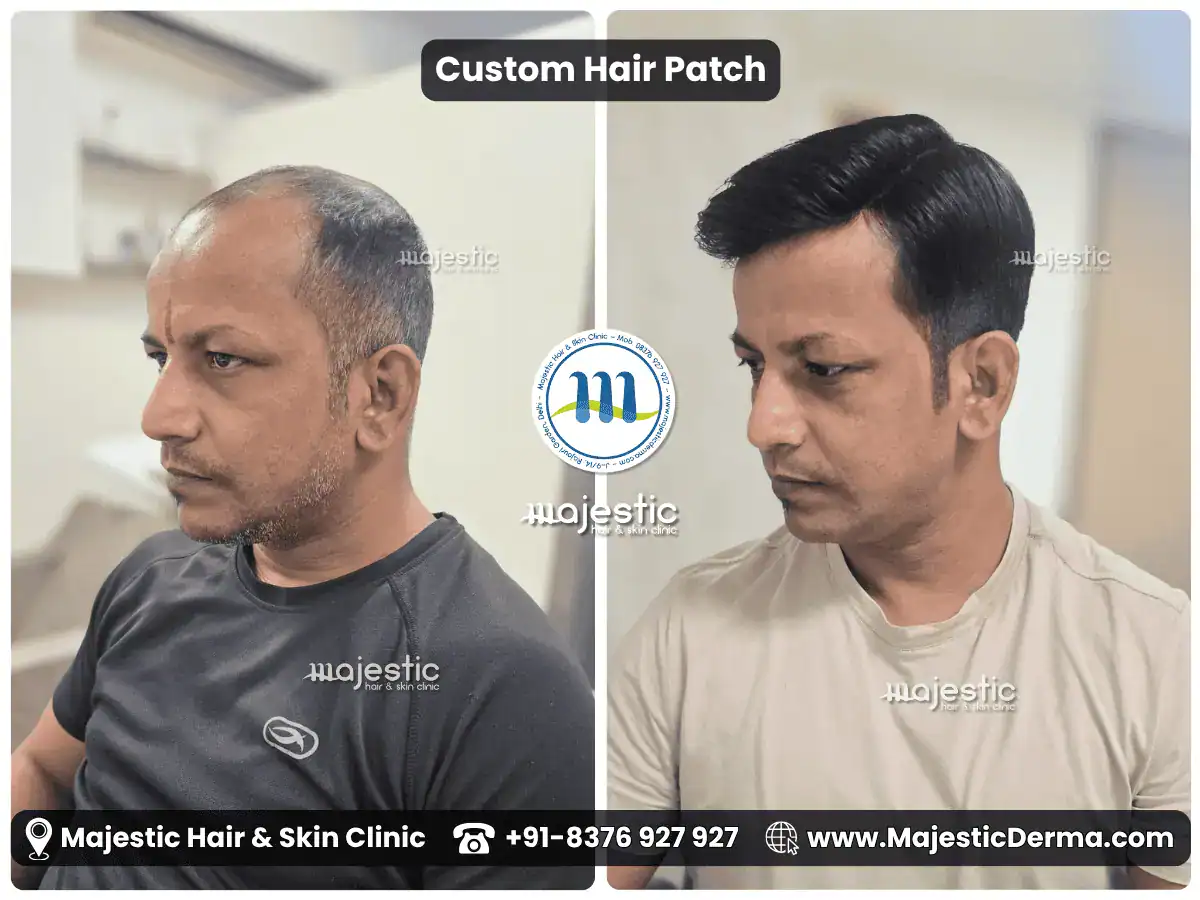 Hair patch before and after: front hairline and crown covered naturally, Rajouri Garden clinic