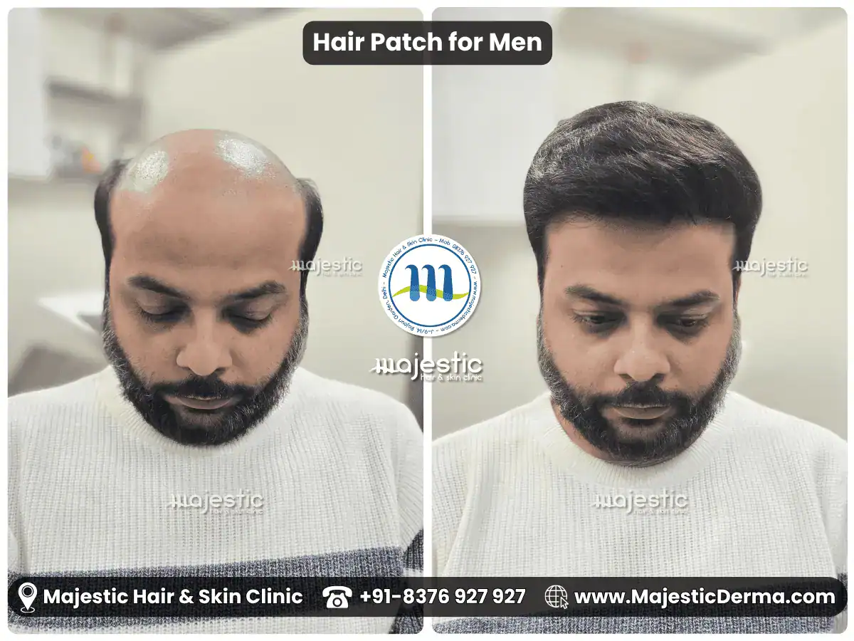 Hair patch result before and after fitting for advanced baldness at Majestic Derma