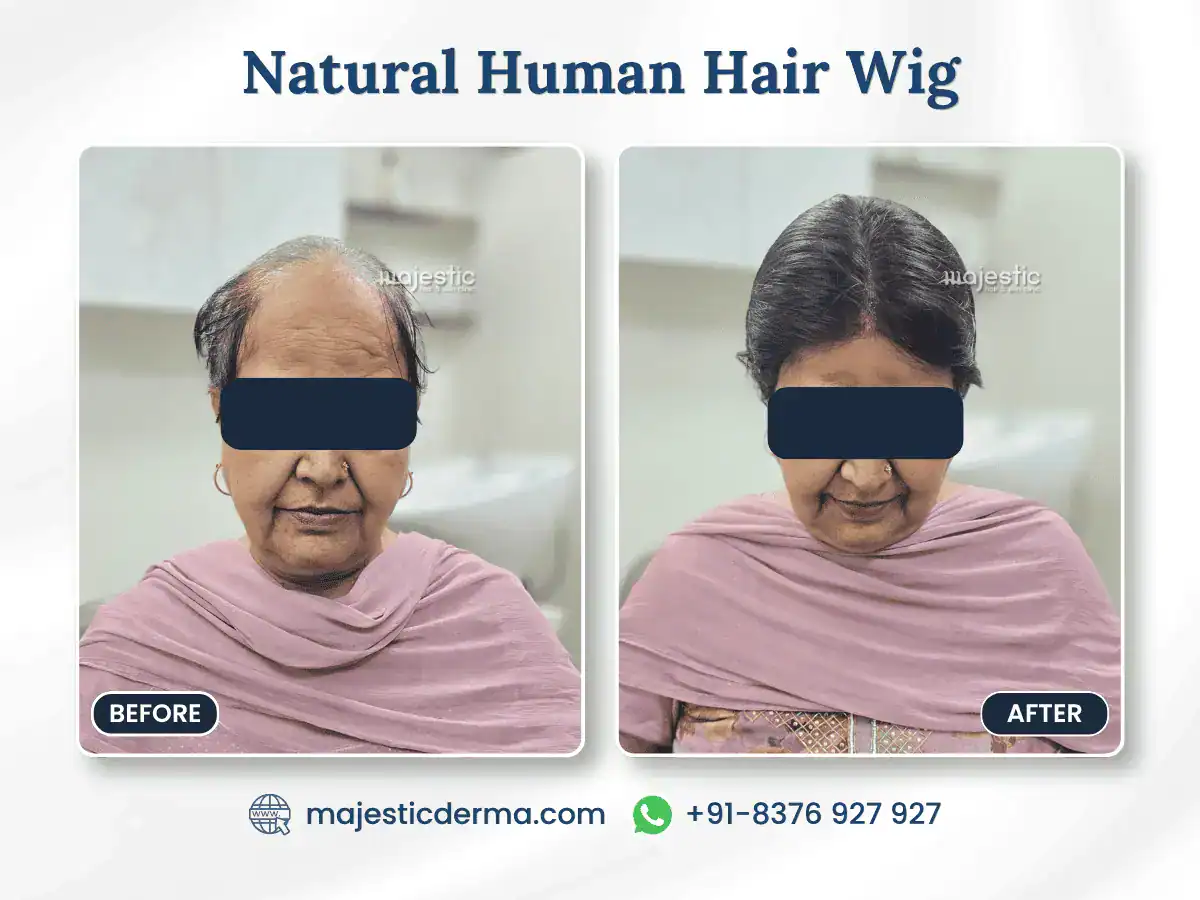 Before and after: a woman with hair loss without and with a natural human hair wig fitted at Majestic